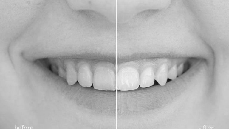 Blanqueamiento dental en Alicante