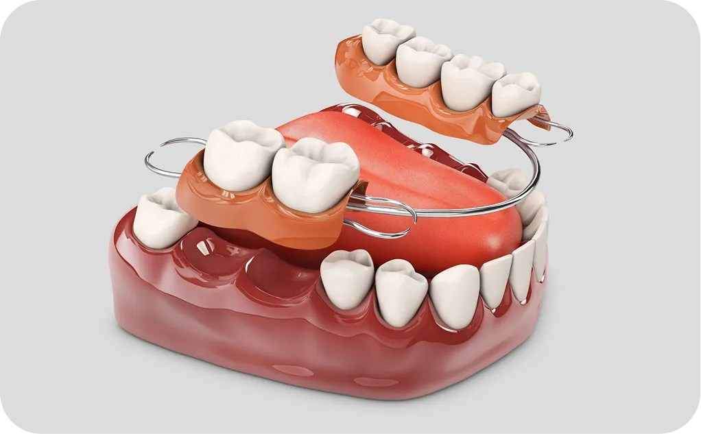 Implantes dentales en Alicante