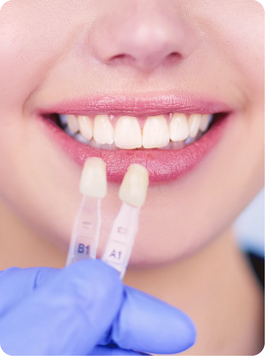 carillas dentales en Alicante