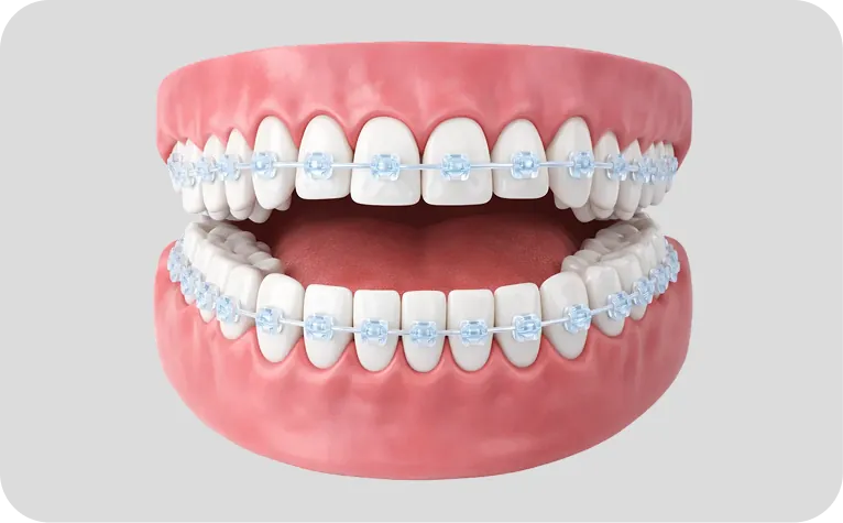 Brackets en Alicante