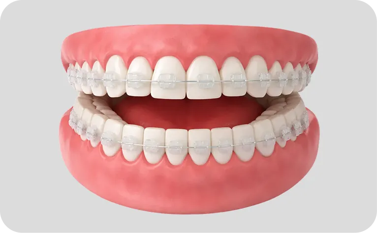 Brackets en Alicante