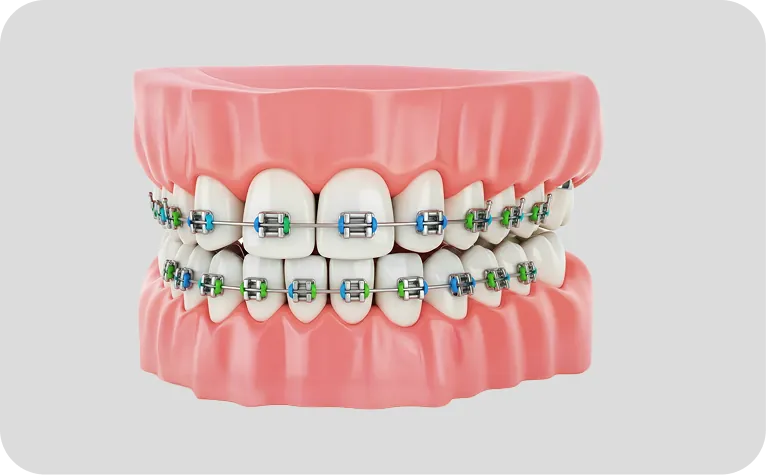 Brackets en Alicante