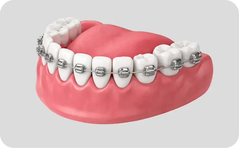 Brackets en Alicante