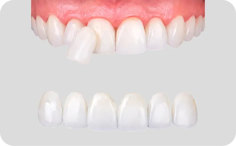 carillas dentales en Alicante